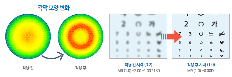 드림렌즈 각막모양 변화/ 착용전 시력 및 착용 후 시력변화