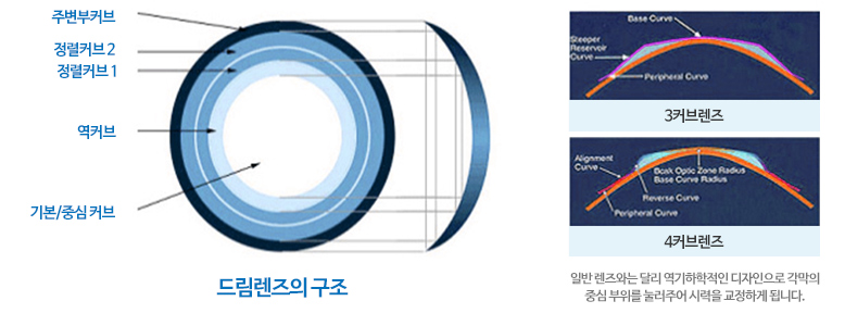 드림렌즈 구조와 원리