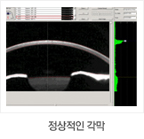 정상적인 각막