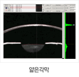 얇은각막