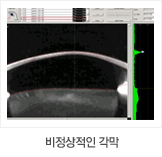 비정상적인 각막