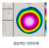 정상적인 각막두께