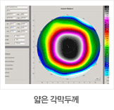 얇은 각막두께