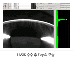 LASIK 수수 후 Flap의 모습