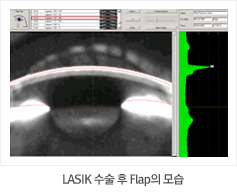 LASIK 수술 후 Flap의 모습