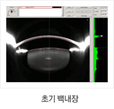 초기백내장