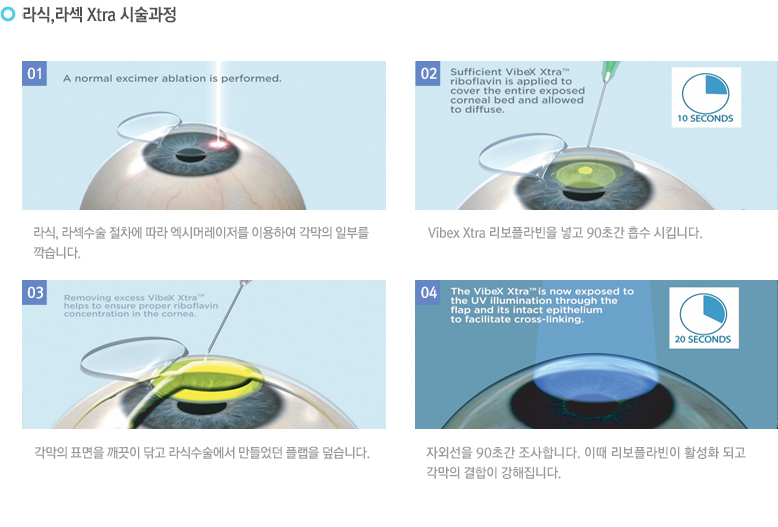 라식,라섹 Xtra 시술과정
			-. 라식, 라섹수술 절차에 따라 엑시머레이저를 이용하여 각막의 일부를 깍습니다.
			- Vibex Xtra 리보플라빈을 넣고 90초간 흡수 시킵니다.
			-각막의 표면을 깨끗이 닦고 라식수술에서 만들었던 플랩을 덮습니다.
			-자외선을 90초간 조사합니다. 이때 리보플라빈이 활성화 되고 각막의 결합이 강해집니다.
			