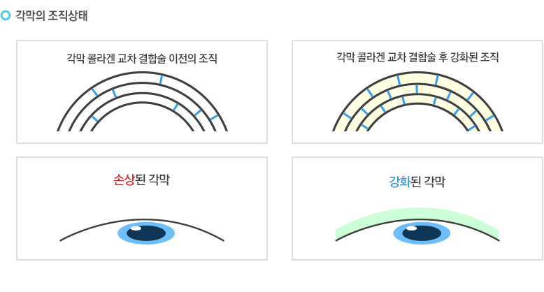 1. 라식,라섹수술 후 각막의 조직은 약해지게 됩니다. 약해진 각막을 그대로 방치하게 되면 원추각막, 근시퇴행 등 부작용이 올 수 있습니다. 라식/라섹 엑스트라는 약해진 각막을 150% 강화시켜 줍니다.
			2. 라식/라섹 엑스트라는 약해진 각막 위에 비타민 B2를 도포 후 UVA를 조사해서 각막의 내구성을 강하게 만들어 수술 후 약해진 각막을 150% 튼튼하게 해 줍니다.
			3. 라식/라섹 엑스트라 시술 후 튼튼해진 각막은 외부의 자극으로부터 내구성이 생겨 수술 후에 생길 수 있는 부작용의 감소는 물론 안전한 눈 건강을 지킬 수 있습니다. 