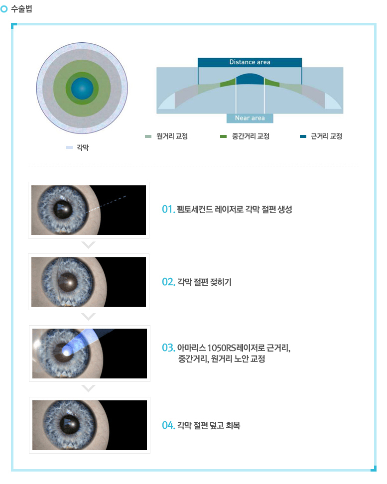 수술법
